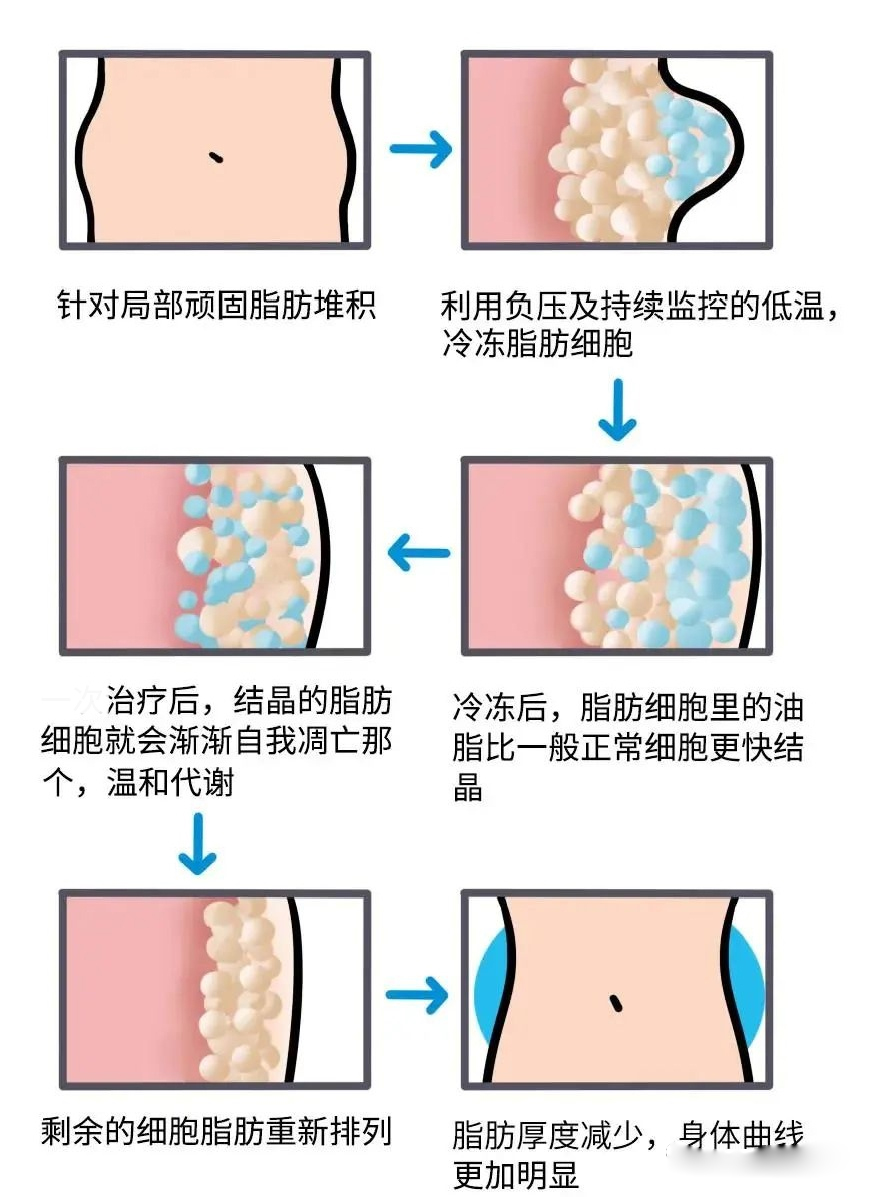 冷凍溶脂減肥儀.jpg