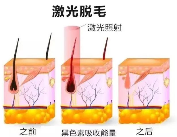 808半導體激光冰點無痛脫毛儀.jpg