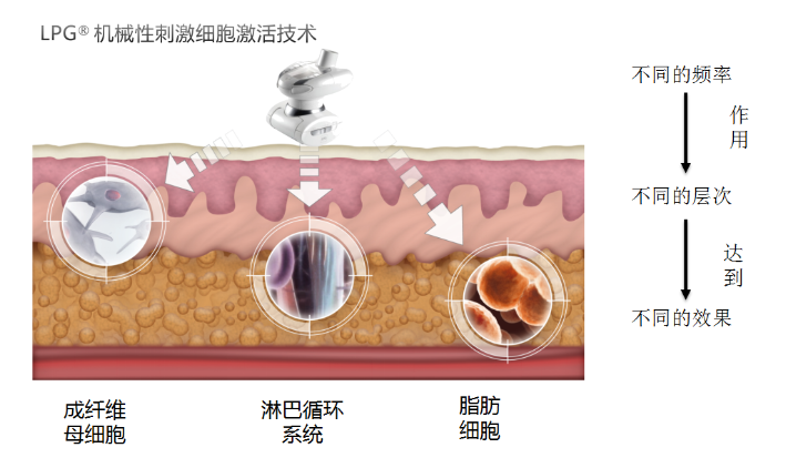 LPG減肥儀.1.png